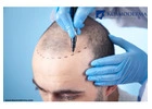 Delhi’s Finest Hair Transplant Clinic Expertise - Kosmoderma 