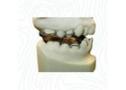 China Orthodontic Lab Offers Superior Twin Block Appliances for Effective Orthodontic Treatment